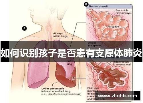 如何识别孩子是否患有支原体肺炎